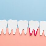 White,Teeth,Bleeding,Cartoon,Made,From,Paper.,Bleeding,Gums,Are