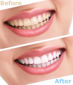 https://smilespanorthjersey.com/wp-content/uploads/bleaching-teeth-treatment-before-and-after-250x292.jpg