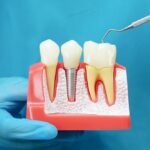 Dentist,Holding,Dental,Implant,,Artificial,Tooth,Roots,Into,Jaw,,Root